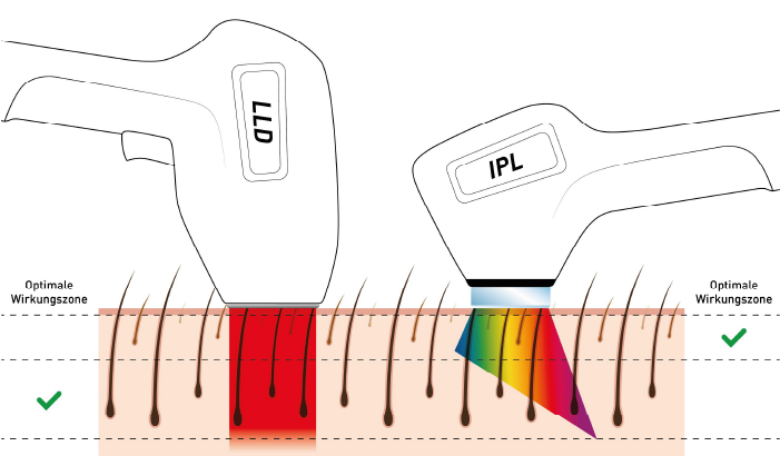 dauerhafte haarentfernung diodenlaser vs ipl